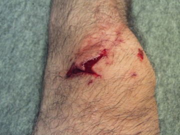 膝の切り傷