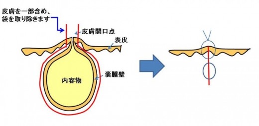 粉瘤